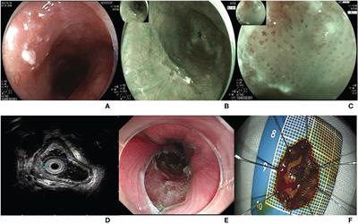 Case report: First case of early adenoid cystic carcinoma and squamous cell carcinoma collision cancer treated by endoscopic submucosal dissection
